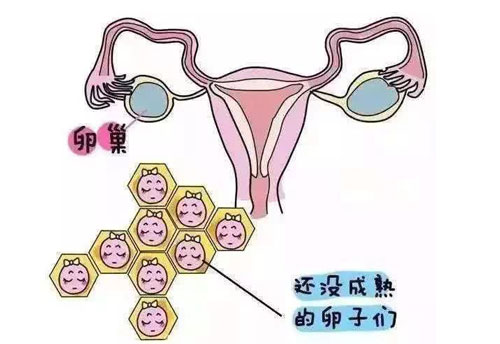 卵子不发育的原因？多囊卵巢综合征是常见原因！