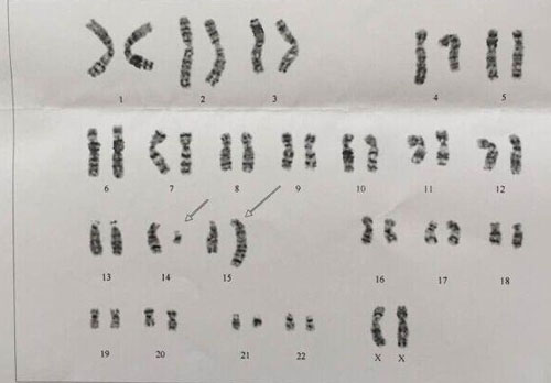 孕前染色体检查吗？孕前为什么要检查染色体？